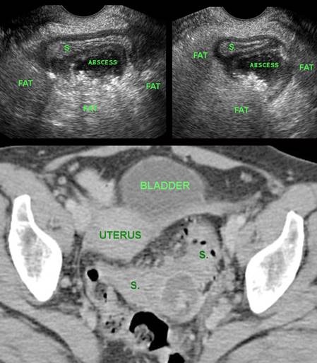 Paracolic diverticular abscess detected with  TVUS