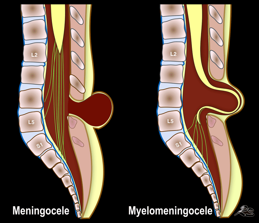 spina bifida occulta cervical spine