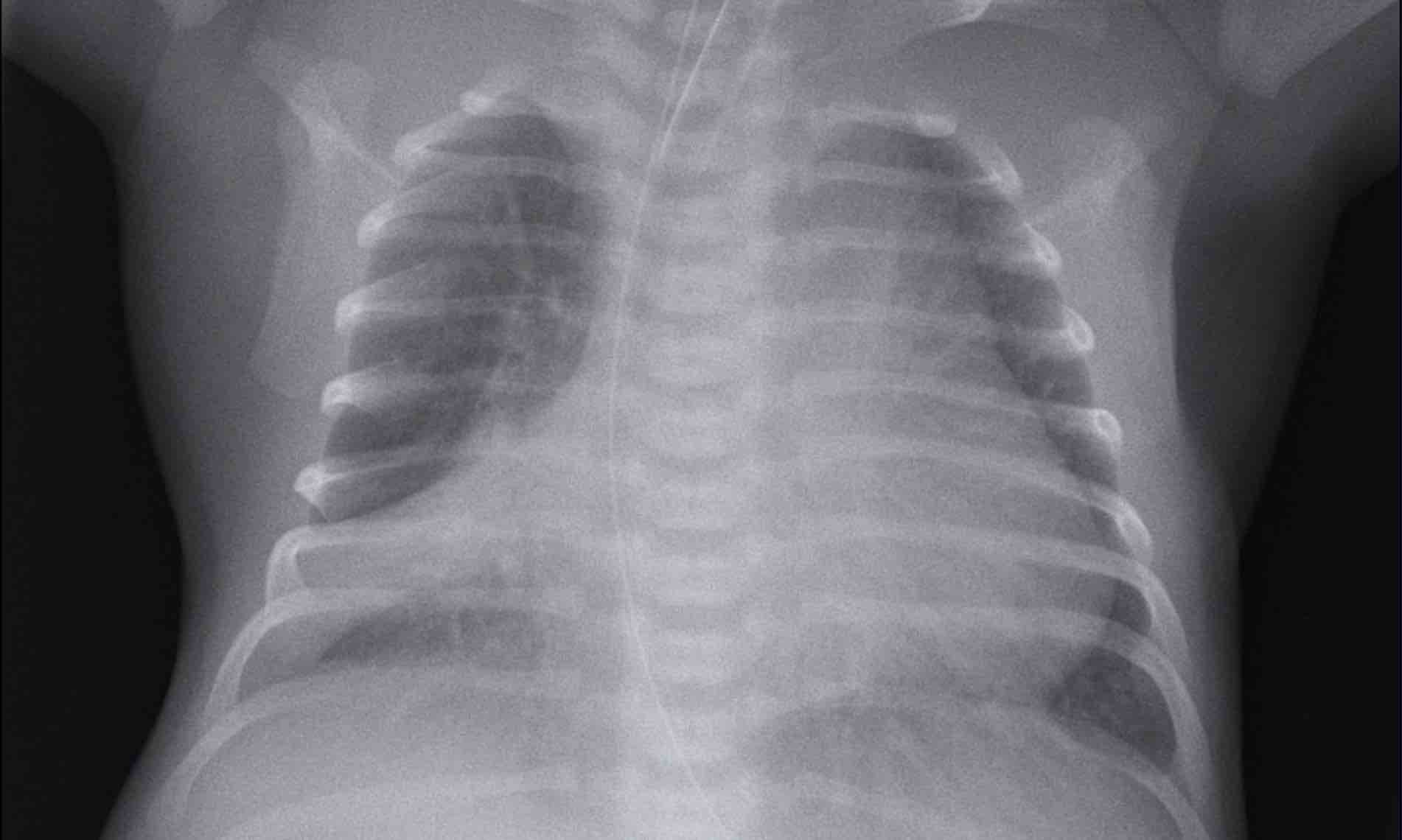 The Radiology Assistant : Neonatal Chest X-Ray