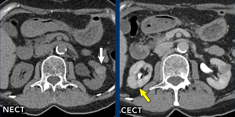 The Radiology Assistant : Bosniak Classification 2019