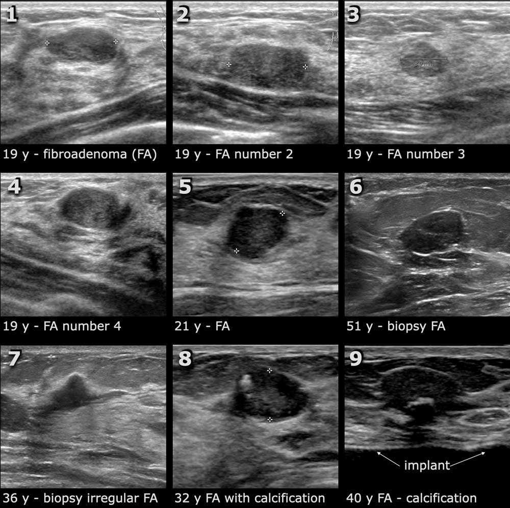 Small mass in breast mammogram, Radiology Case