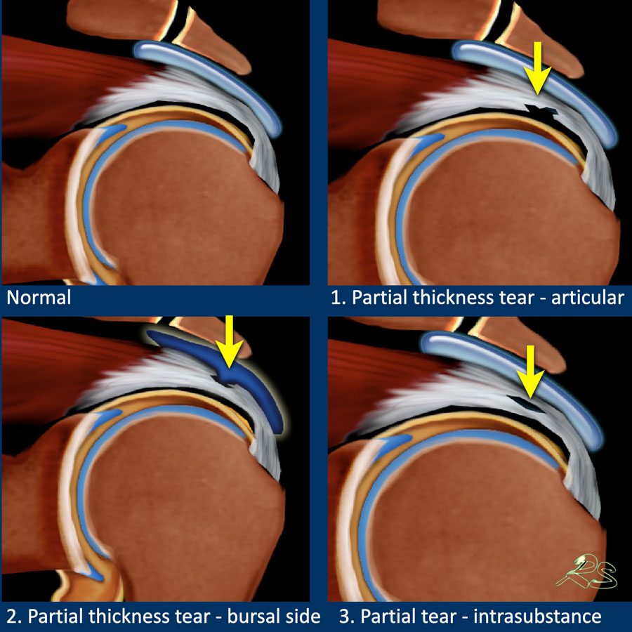 The Radiology Assistant Shoulder Rotator cuff injury