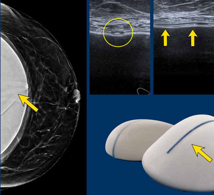 The Radiology Assistant : Breast Implants