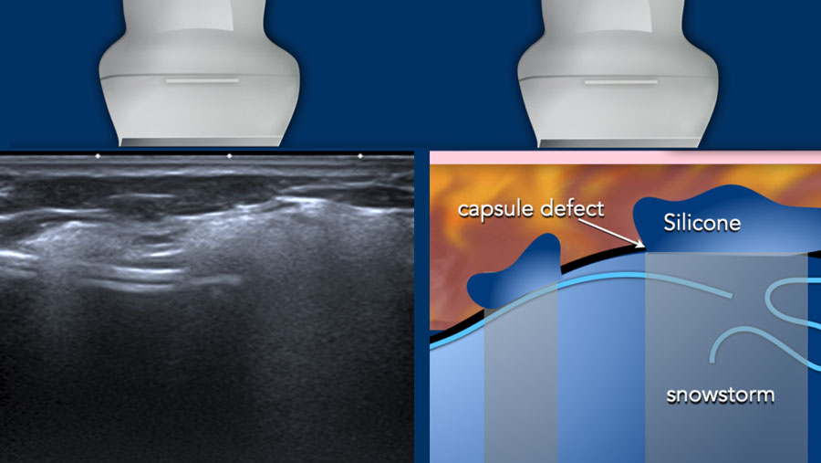The Radiology Assistant : Breast Implants
