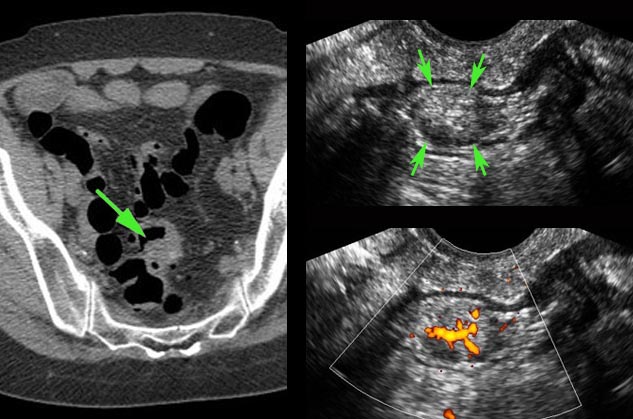 Adenomatous polyp in the sigmoid, detected by TVUS.