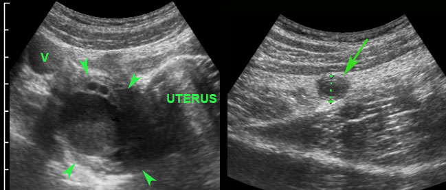 Pitfall: asymptomatic right ovarian cyst in woman with appendicitis.  (V= iliac vein)