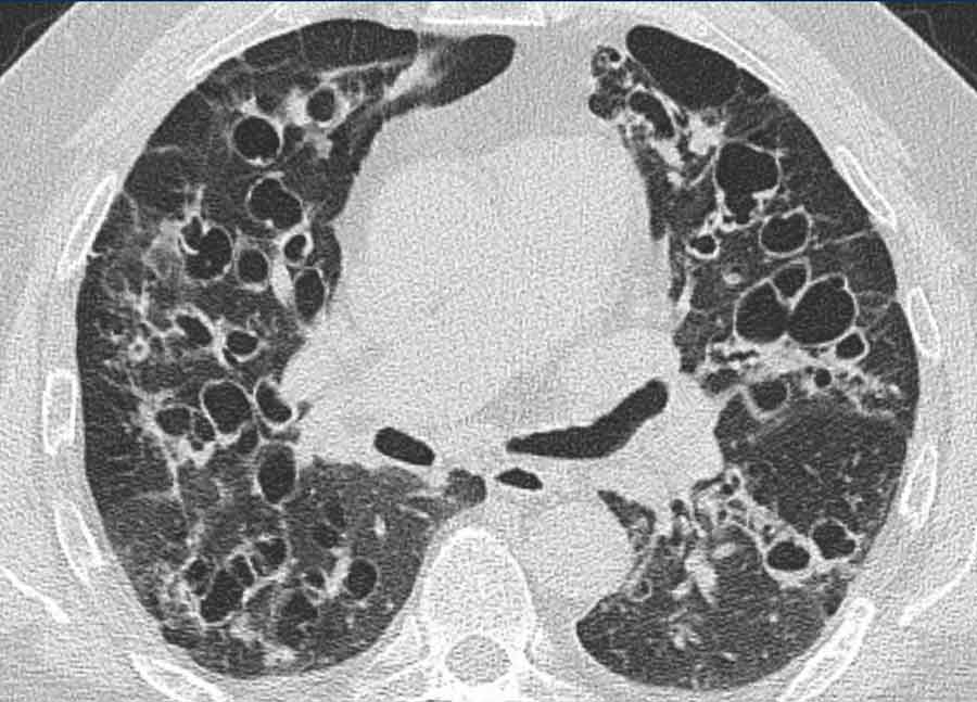 Williams-Campbell syndrome with widespread bronchiectasis