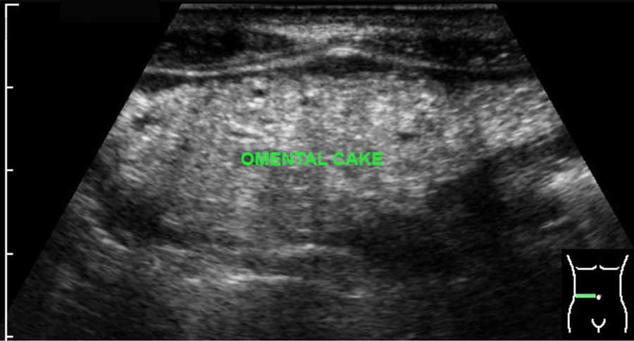 US of the Peritoneum | RadioGraphics