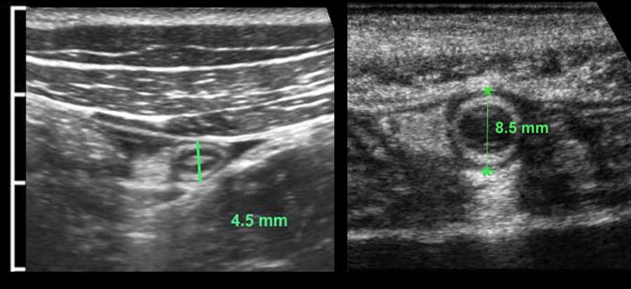 The Radiology Assistant Ultrasound Of The GI Tract Normal Anatomy