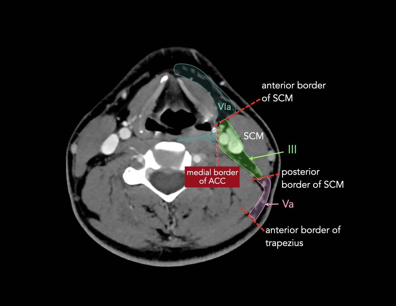 The Radiology Assistant : Cervical Lymph Node Map (2023)