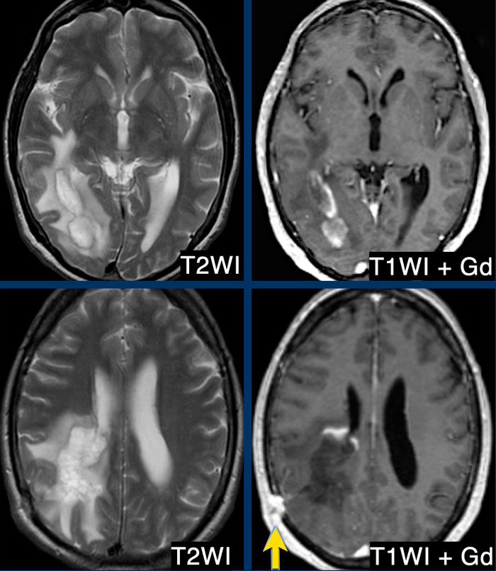 Neuro-image: developmental venous anomaly and central vein sign in multiple  sclerosis | SpringerLink