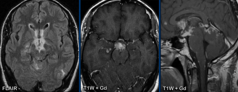 Cns Pattern The Radiology Assistant : Enhancement Patterns in CNS disease
