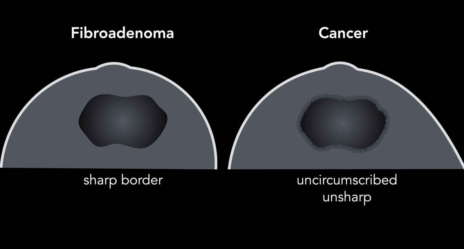 Fibroadenomatosis Fibroadenoma Abscess Tumor Cyst In The