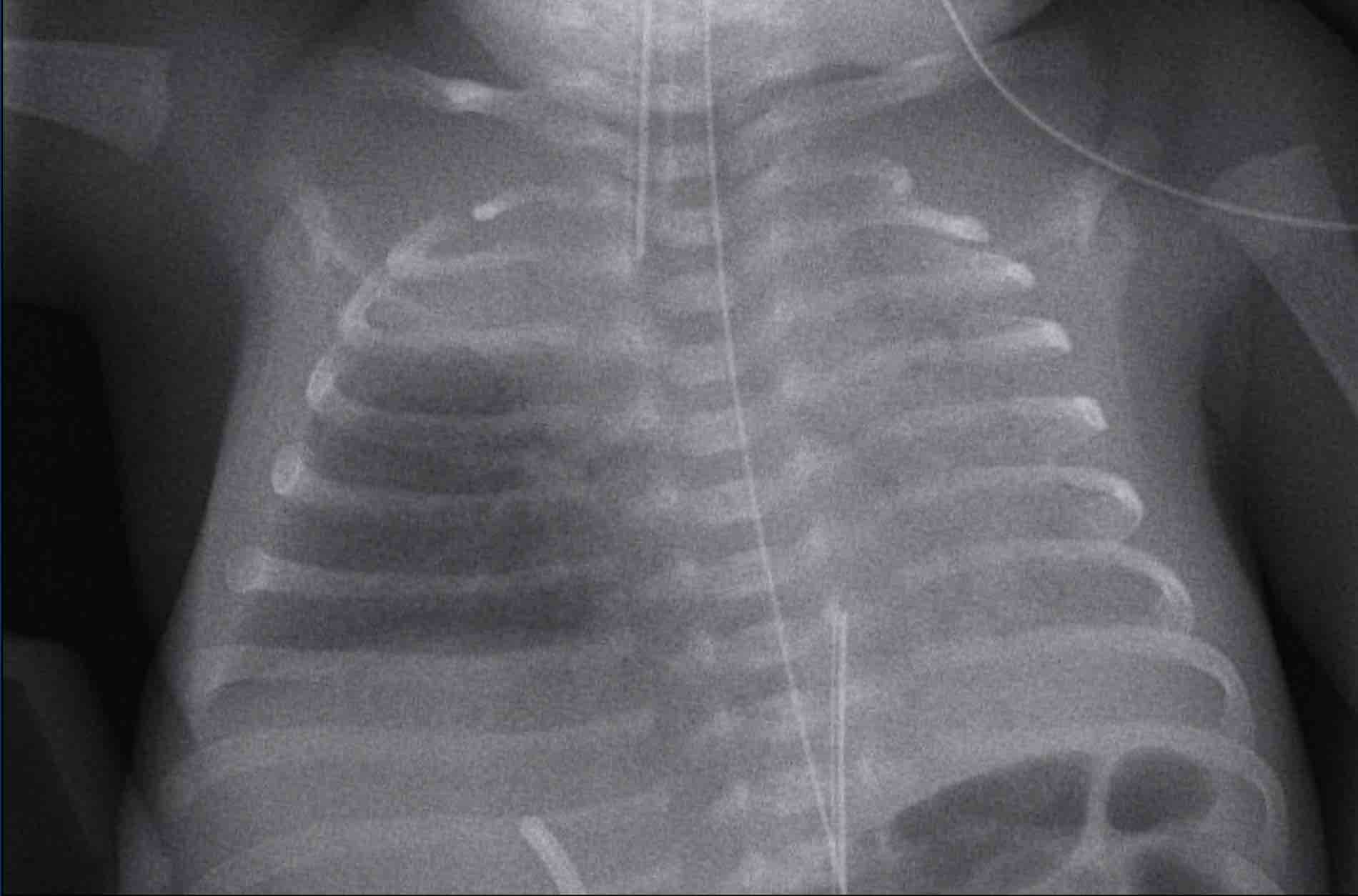 The Radiology Assistant : Neonatal Chest X-Ray