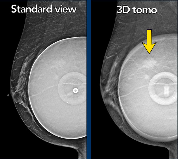Identifying If Breast Implants Have Shifted