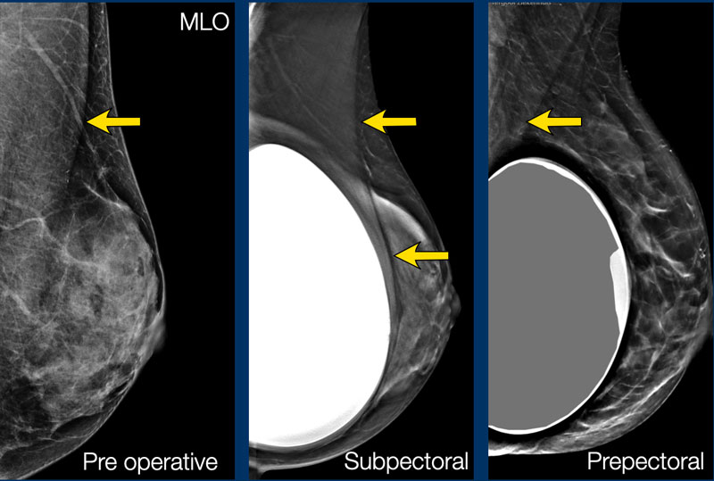 The Radiology Assistant Breast Implants 