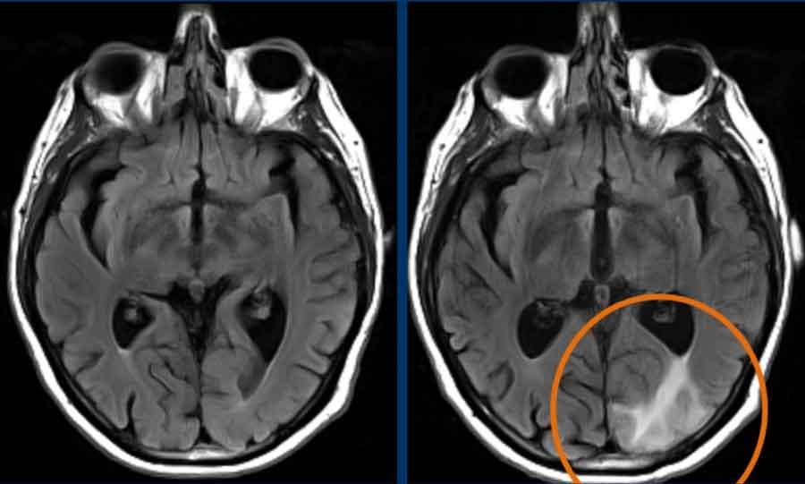 ARIA-E with edema in the right occipital lobe