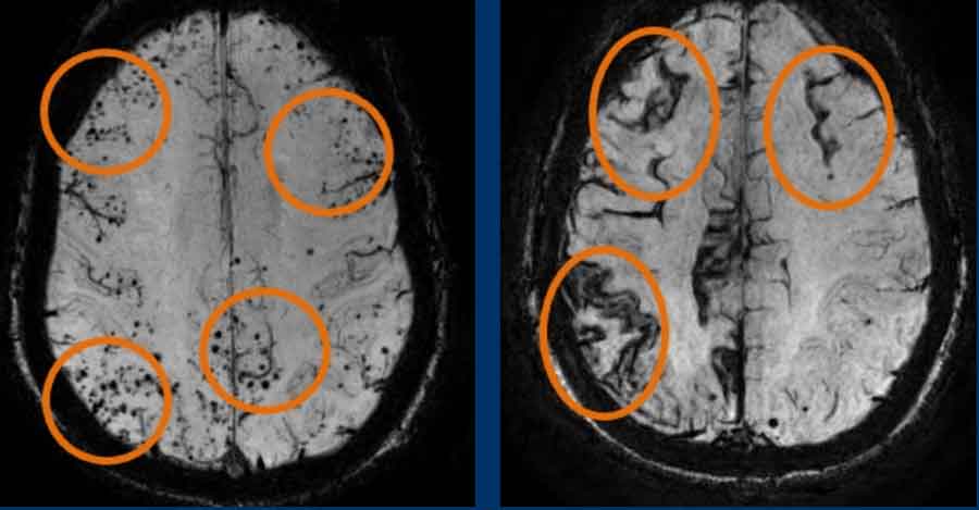 ARIA-H with micro-hemorrhages and superficial siderosis.