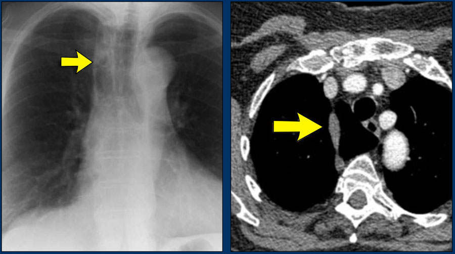 Azygos Vein Chest X Ray