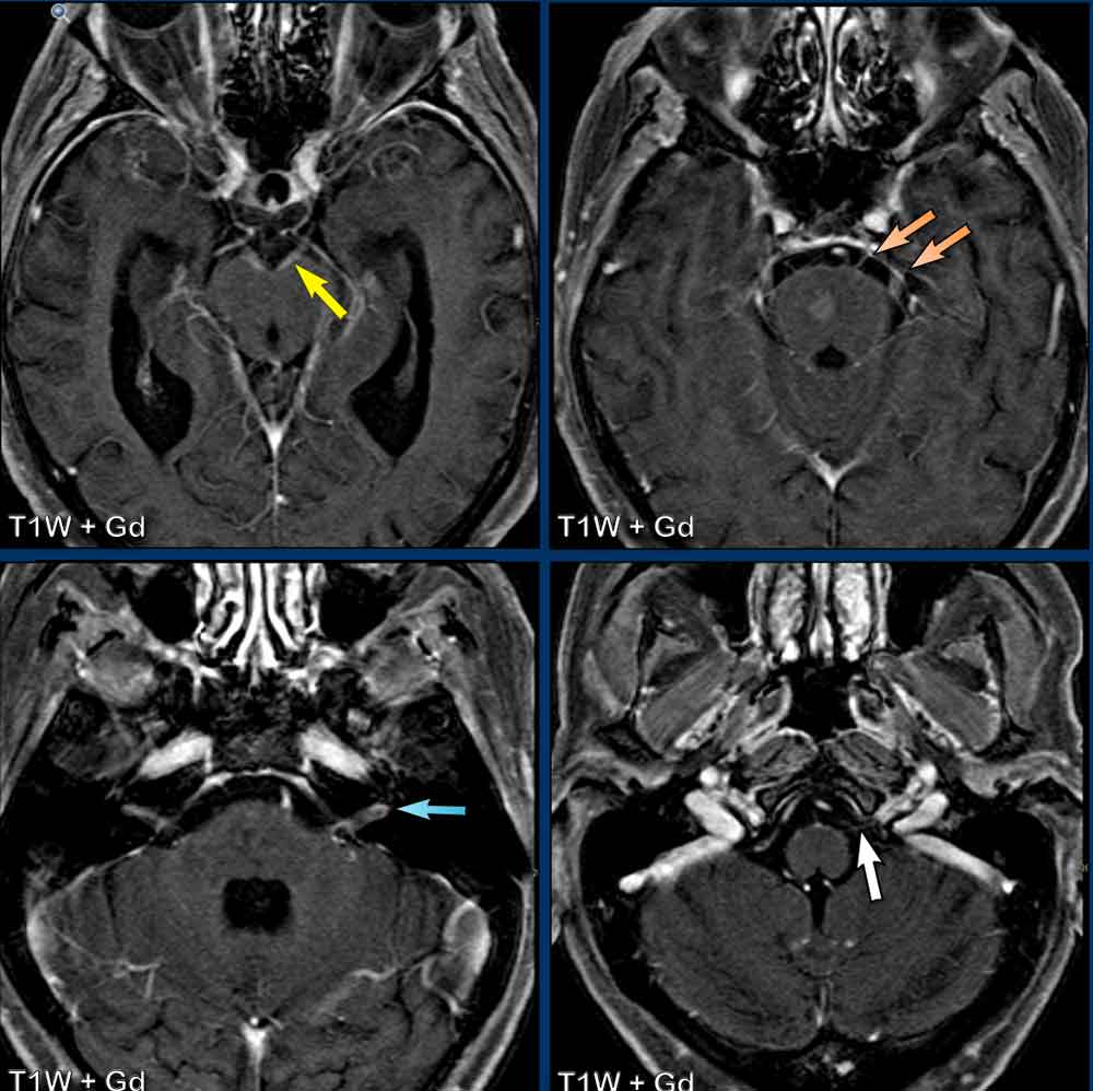 Role of MRI in Evaluation of Ring Enhancing Lesions of Brain in Correlation  with Mr Spectroscopy
