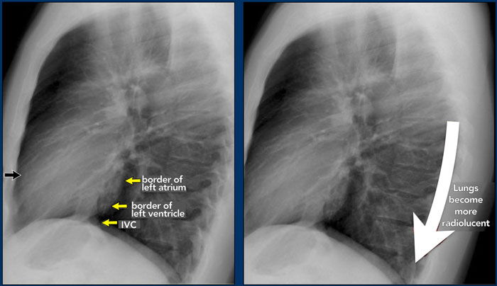 systematic review of chest x ray