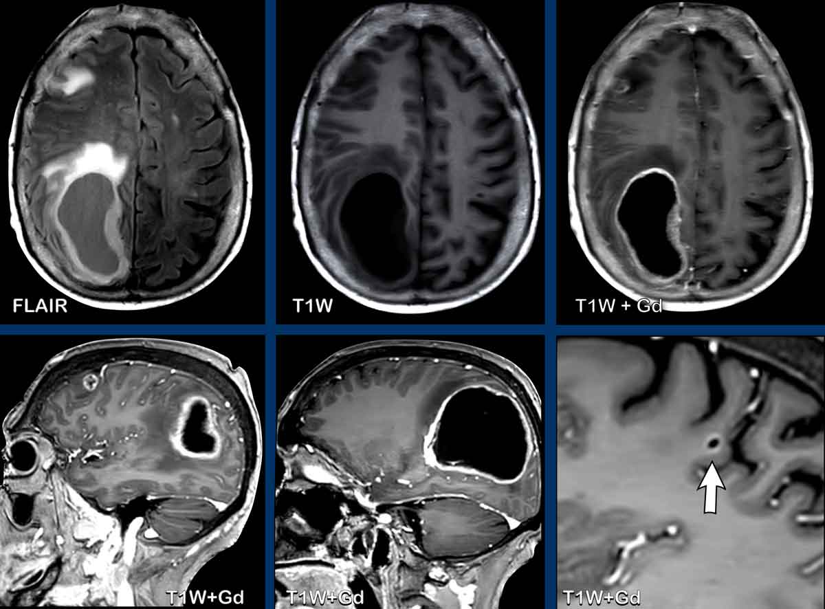 Imaging Mimics of Brain Tumors | Radiology Key