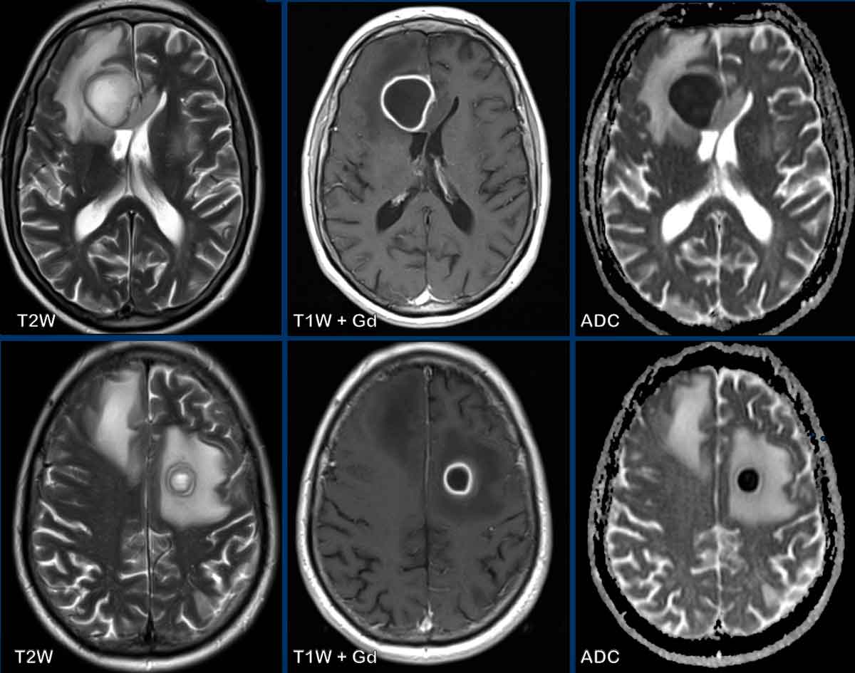 Cureus | Vanishing Pseudotumoral White Matter Lesions Presenting as Aphasia  and Altered Mental Status in a 71-Year-Old Male | Article