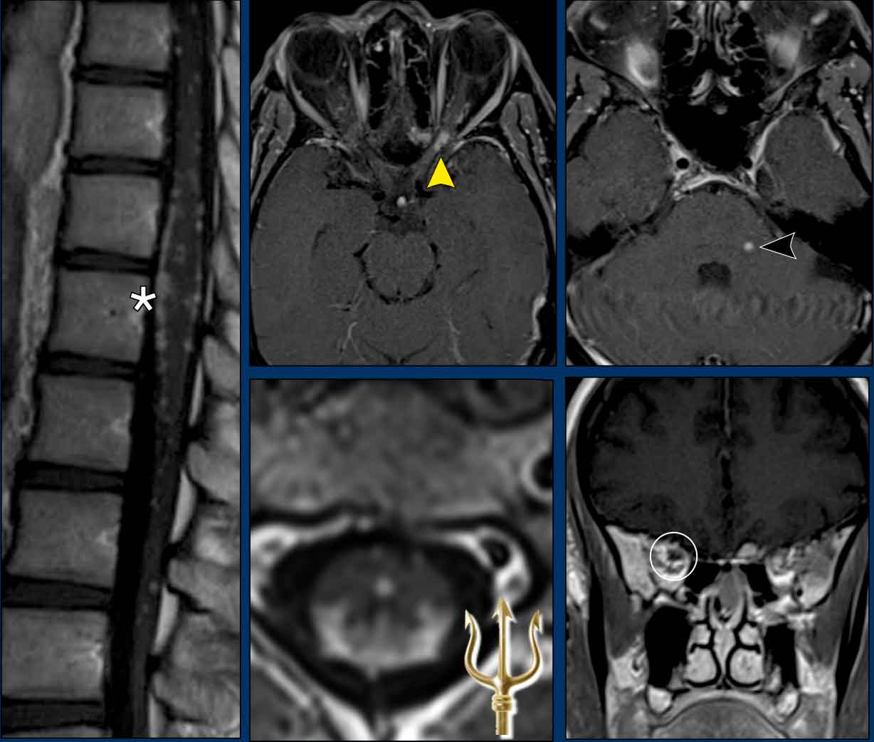 ‘Trident’ sign in a patient with spinal neurosarcoidosis