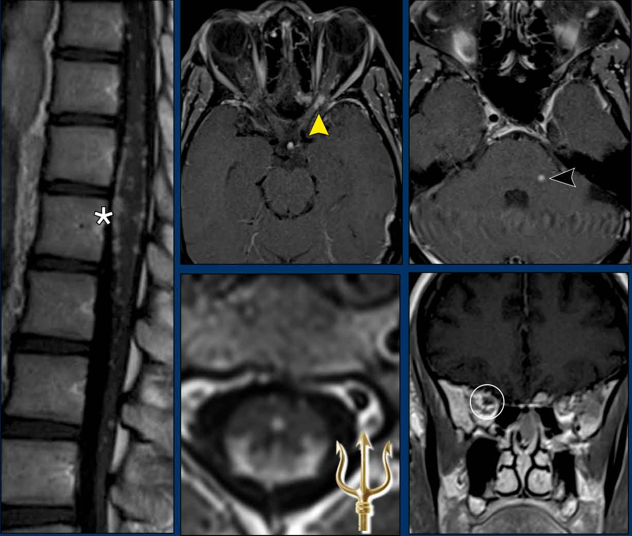 The Radiology Assistant Enhancement Patterns In CNS Disease The Radiology Assistant Enhancement Patterns In CNS Disease