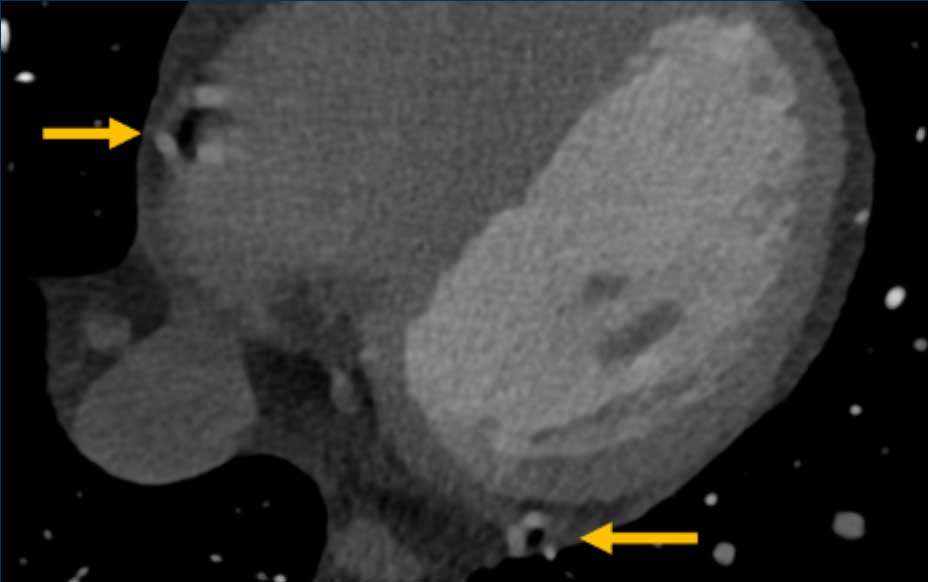 Example of a non-diagnostic scan. Both the RCA and LCX are blurred due to motion artifacts, resulting in CAD RADS N.
