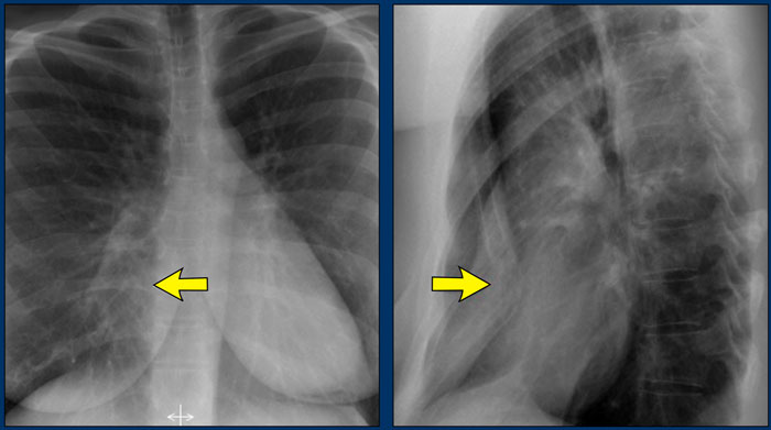 Normal Female Chest Radiograph –