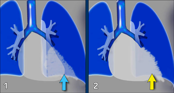 1. No silhouette sign in a consolidation located in the left lower lobe (blue arrow). 2. Silhouette sign in a consolidation in the lingula lobe (yellow arrow).