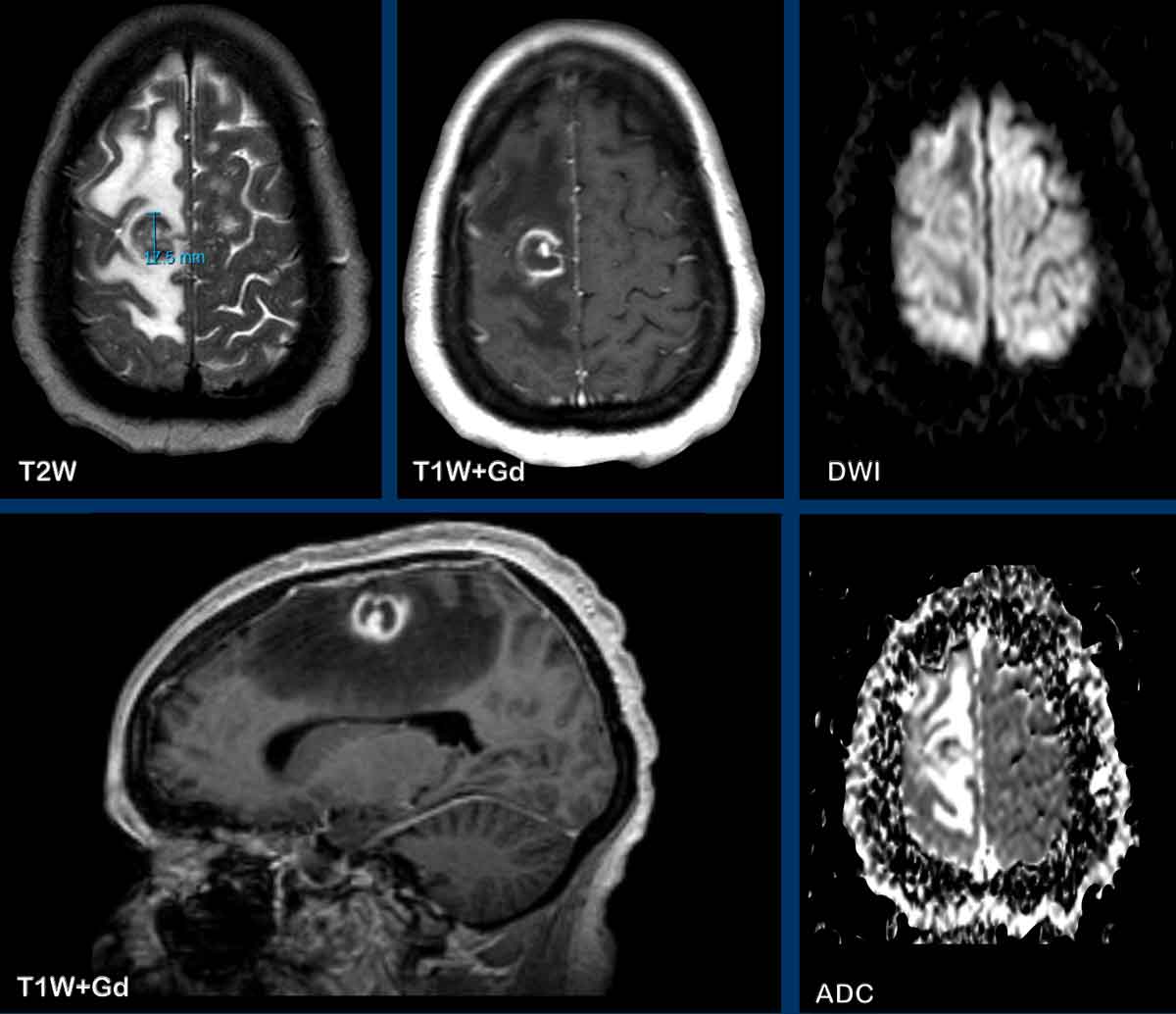 Ring enhancing brain lesions in a patient with Acquired Immunodeficiency  Syndrome (AIDS): a diagnostic dilemma