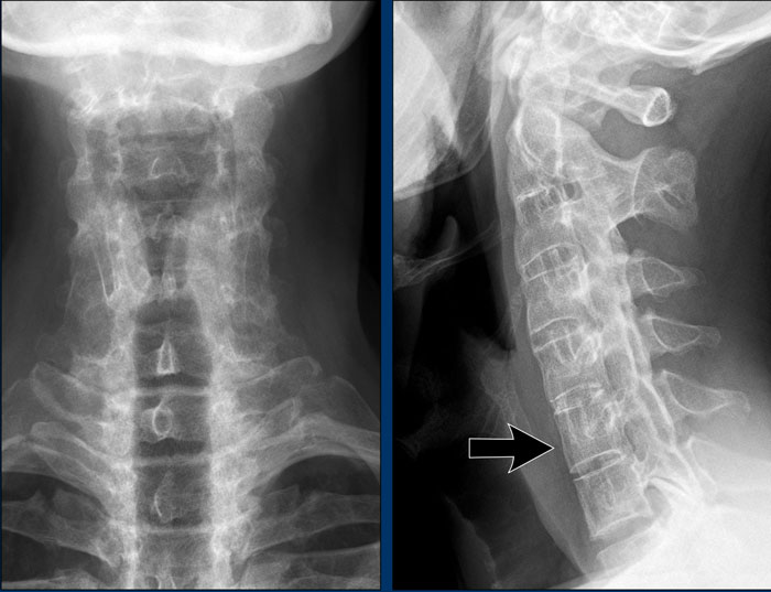 The Radiology Assistant : Arthritis