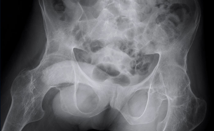 Ankylosis of the hip joints
