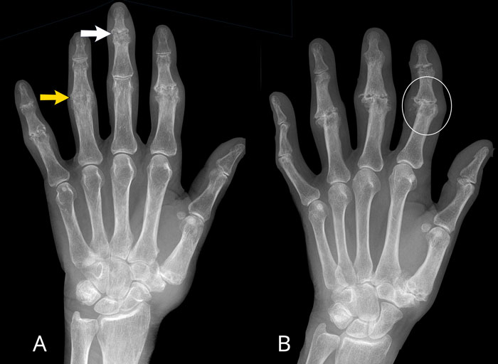 The Radiology Assistant : Arthritis