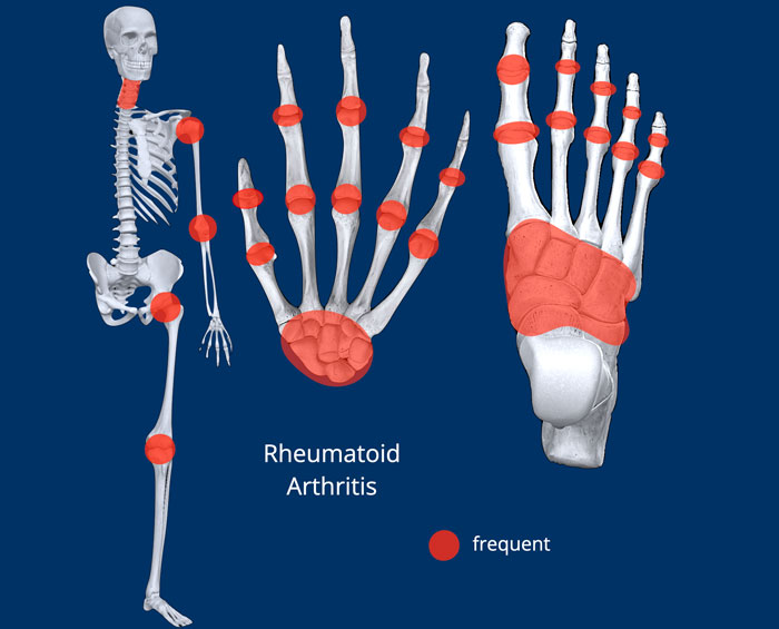 The Radiology Assistant Arthritis