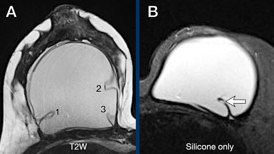 The Radiology Assistant Breast Implants