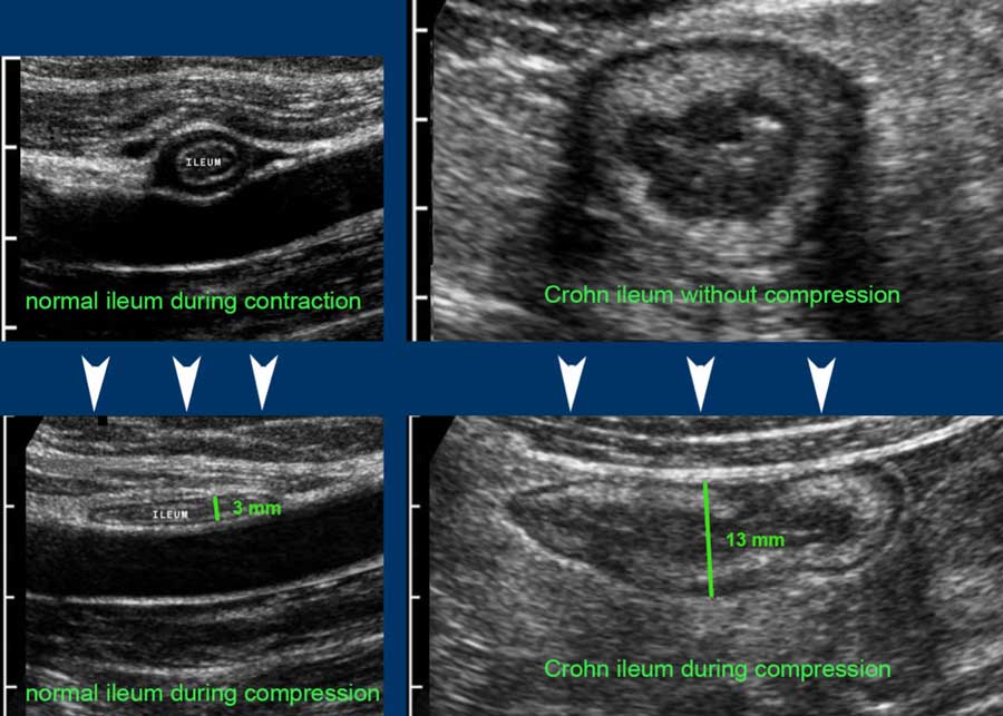 Ultrasound Measurements Radiology Assistant At Tracy Mcfall Blog
