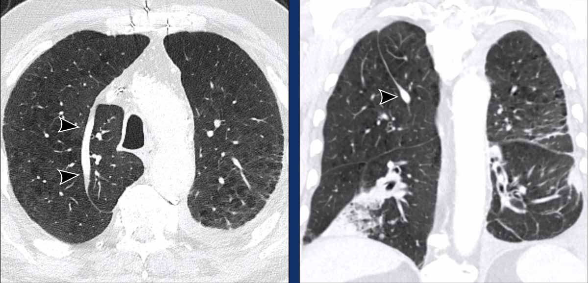 The Radiology Assistant : Lung Segments And Bronchi