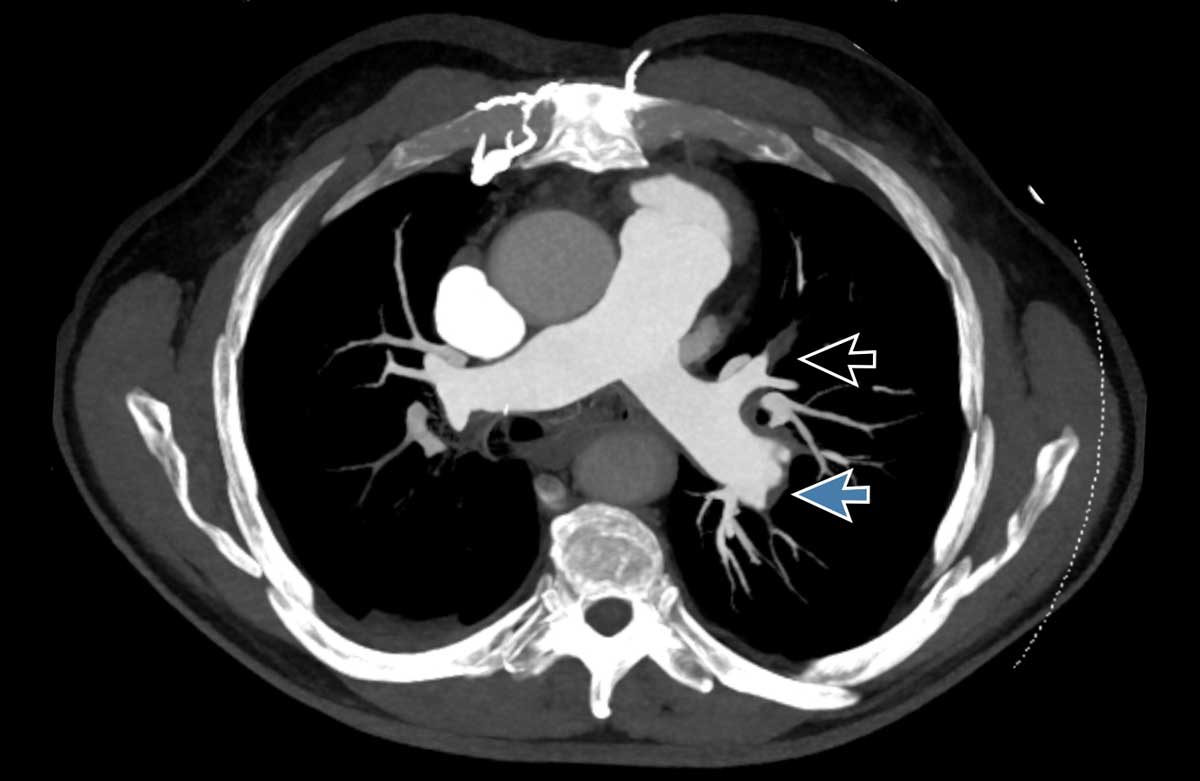 The Radiology Assistant : Lung Segments and Bronchi