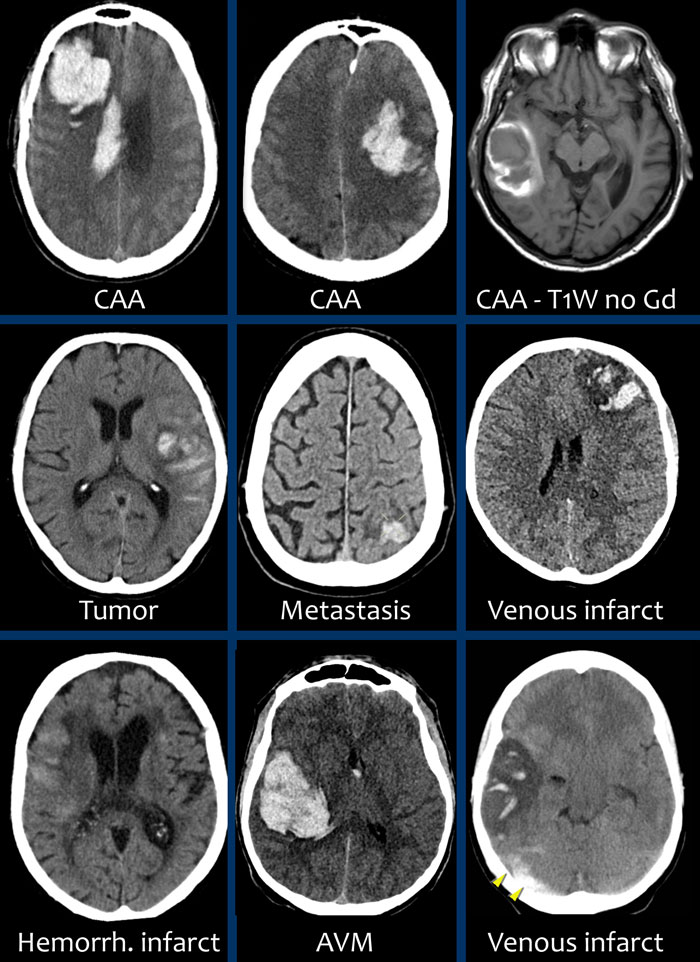 Right lower image is venous infarction due to sinus thrombosis (yellow arrows)