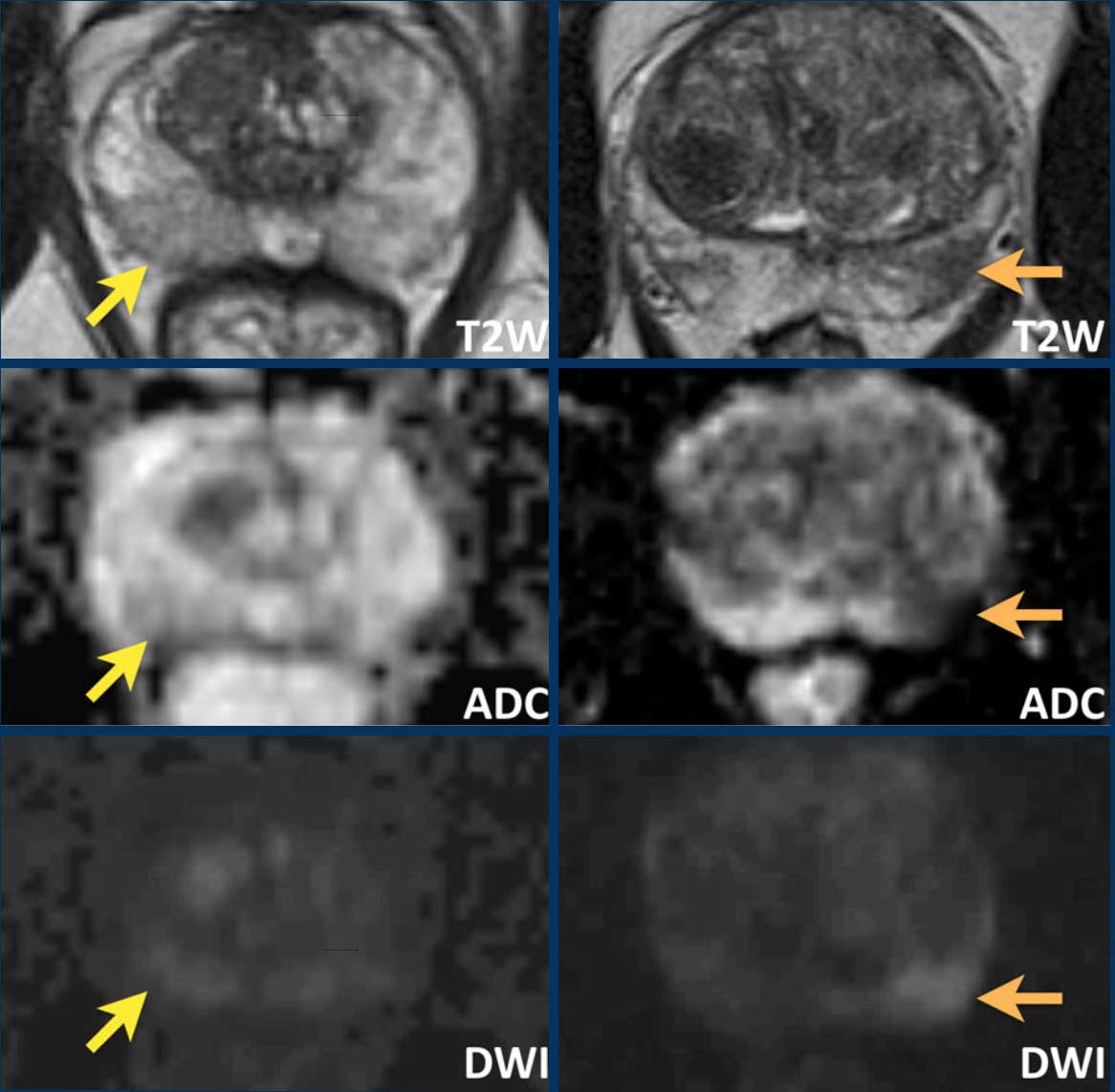 Differences between prostatitis ( images on the left) and  prostate cancer (images on the right)