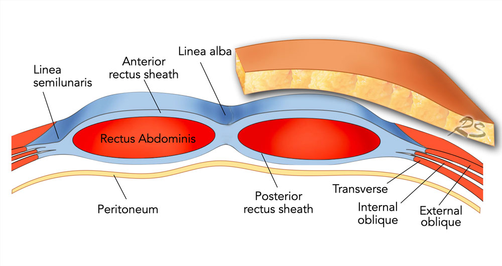 The Radiology Assistant : Abdominal Wall Hernias