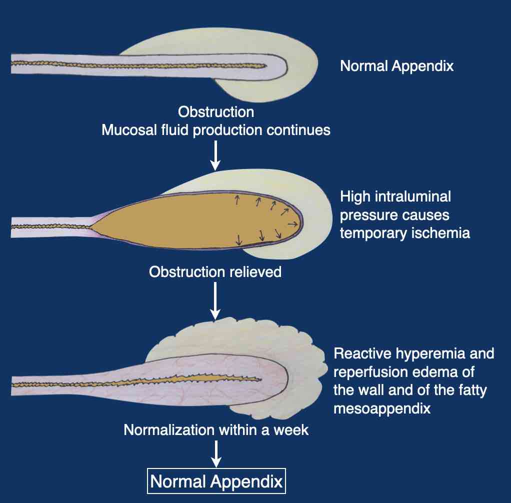 Appendicitis Diagram