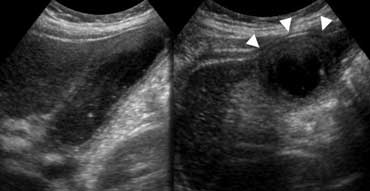 Longitudinal and transverse US show  thickened  gallbladder wall. The gallbladder is noncompressible ('hydropic') and causes an  impression in the anterior abdominal wall (arrowheads).