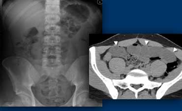 LEFT: Plain abdominal film in a patient with an acute abdomen, showing no abnormalities. RIGHT: Subsequent CT shows distended small bowel loops (arrowheads) that are not seen on plain abdominal film because they are filled with fluid only and do not contain intraluminal air.