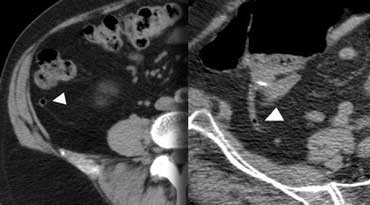 Normal appendix: CT shows an air-containing non-distended appendix (arrowheads), with homogeneous low-density periappendiceal fat.