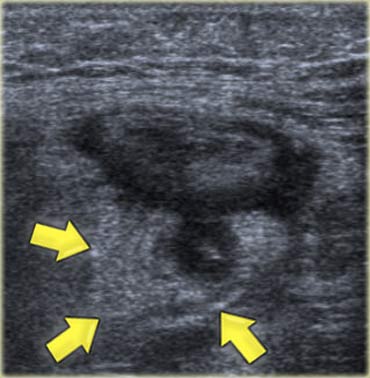 Sigmoid diverticulitis at sonography. A hypoechoic thickened diverticulum is surrounded by hyperechoic inflamed fat (arrows).