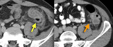 LEFT: Sigmoid diverticulitis. Diverticulum (arrow) is surrounded by hyperattenuating fat. The sigmoid wall is thickened. RIGHT: Sigmoid carcinoma with limited fat stranding.